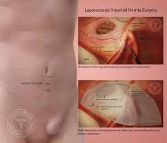 Image result for Inguinal hernia man