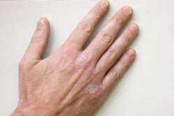Hilfe bei neurodermitis und schuppenflechte die neurodermitis (atopisches ekzem) und die schuppenflechte (psoriasis) gehören zu den chronischen entzündlichen hauterkrankungen. Neurodermitis Der Hand