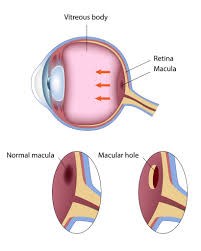 macular hole