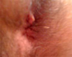 Plicoma Anal Colonoscopia Coloproctologia Endoscopia