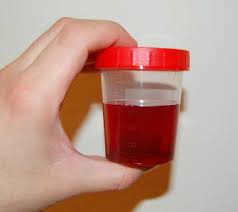 Blut Im Urin Med Kom