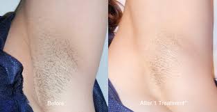 What to expect during laser hair removal. Laser Hair Removal Orlando Fl