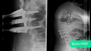 Image result for Spinal Trauma