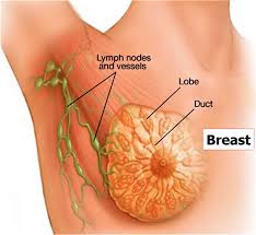 Lymphoma, also called lymphatic cancer shows symptoms including a painless lump. Lump In Armpit Painless Painful Lump Causes Diagnosis And Treatment
