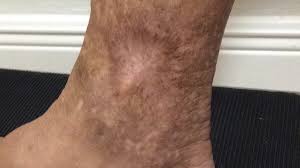 Image result for Lipodermatosclerosis