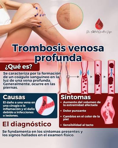 La 𝘁𝗿𝗼𝗺𝗯𝗼𝘀𝗶𝘀 𝘃𝗲𝗻𝗼𝘀𝗮 profunda es una condición médica grave  en la cual se forma un coágulo de sangre en una vena profunda del cuerpo,  típicamente en las piernas. Este coágulo puede obstruir