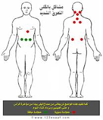 مركز الحجامة في الاردن مواضع عمل الحجامه لمشاكل الكلى
