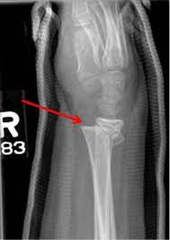 There are many different symptoms associated with a fracture. Orthokids Forearm Fractures