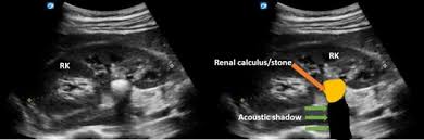 Image result for Nephrolithiasis Imaging
