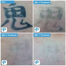 For example, newer black tattoos with thick lines usually require 6 to 12 sessions to remove, while older homemade tattoos may be eliminated in 1 to 3 sessions. Laser Tattoo Removal Before And After Photos Premium Tattoo Removal