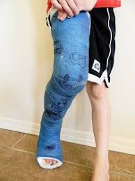A Kid In A Leg Cast Leg Cast Legs It Cast