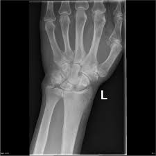 Due to its structural complexity, the tfcc is vulnerable to damage. Triangular Fibrocartilage Complex Tear With Scapholunate Advanced Collapse And Dorsal Intercalated Segment Instability Radiology Case Radiopaedia Org