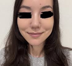 Rhinoplasty at Eight Plastic Surgery