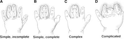 1, 2 classically, it consists of a combination of unilateral aplasia of the sternocostal portion of the pectoralis major muscle (pmm) and hypoplasia of the ipsilateral hand, with syndactyly. Syndactyly Hand Orthobullets