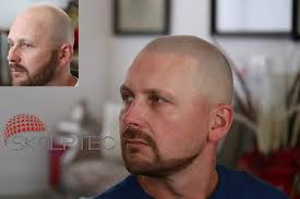 For those who do go bald, it can be hard to take. Hair Tattoo Best Hair Tattoo Solution For Hair Loss Skalptec Ltd