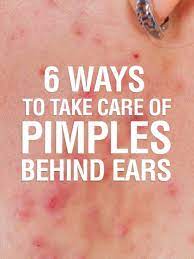 Pimples Behind The Ears 6 Home Remedies And Causes Ear Pimple How To Get Rid Of Pimples Pimples