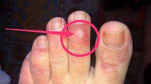 Reuma sa prejavuje predovšetkým na prstoch rúk, nôh alebo v kolene. Zmeny Na Prstoch Mozu Byt Dalsim Nezvycajnym Priznakom Covid 19