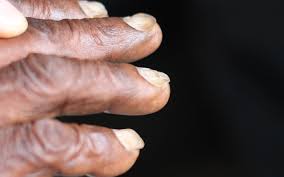 Plummer's nail is a clinical sign in which there is onycholysis, or separation of the nail from the nail bed, particularly affecting the ring and little fingers. Koilonychia Wikipedia