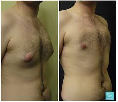 Male Breast Reduction Cost Gynaecomastia Surgery Before And After Photos Uk