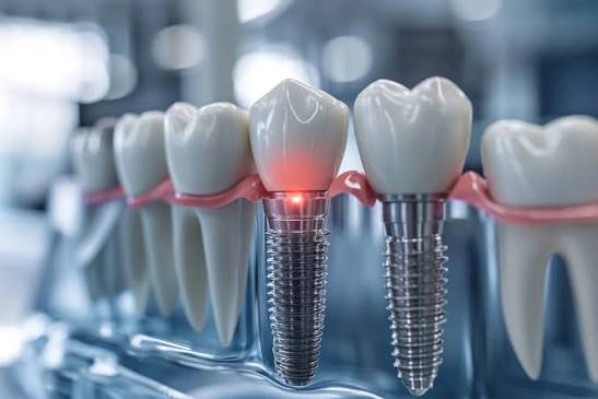 Dental Implants vs Dentures: Which is Right for You?