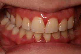 Gingivitis can cause dusky red, swollen, tender gums that bleed easily, especially healthy gums are firm and pale pink and fitted tightly around the teeth. Gum Disease Pictures What Do Healthy Gums Look Like