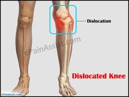 For many treatments, including dislocated shoulder surgery in glenview, contact the offices of dr. Dislocated Leg At Knee Cheaper Than Retail Price Buy Clothing Accessories And Lifestyle Products For Women Men