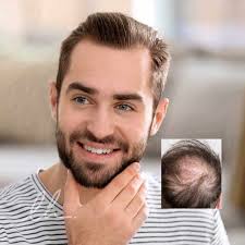 A staff of 11 doctors who specialize in hair transplants cover the centers, traveling from center to center to meet patients as needed. Hair Transplants Birmingham Alabama Steve Latham Hair Restoration Clinic Huntsville Alabama