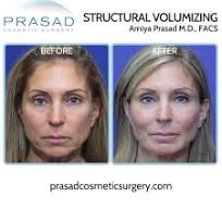 Cheek Filler Before and After, and What You Need to Know