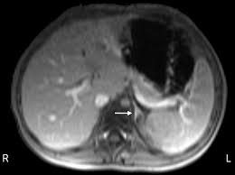 Integrated Imaging Using MRI and 123| Metaiodobenzylguanidine Scintigraphy  to Improve Sensitivity and Specificity in the Diagnosis of Pediatric  Neuroblastoma | AJR