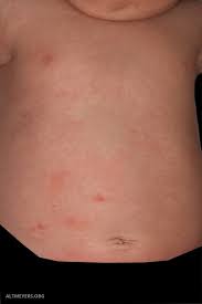 Verwenden sie den chatbot, um ihre suche weiter zu verfeinern. Melanose Transiente Neonatale Pustulose Altmeyers Enzyklopadie Fachbereich Dermatologie