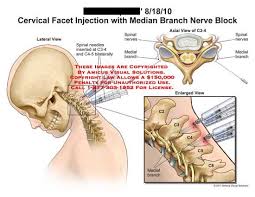 Cervical Facet Injection With Median Branch Nerve Block Cervical Nerve Spinal Injury