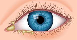 What Really Causes Eye Discharge Itchy Eyes All About Vision Crusty Eyes