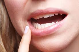 Herpes ist ein virus, dass du dein leben lang in. Beauty Hausmittel 30 Geheimtipps Und Mythen Brigitte De