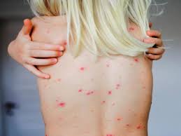 Image result for vyrážka u dětí