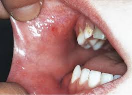 Image result for Labial mucosa