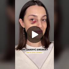 Jak zakryć siniaka skutecznie i szybko