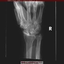Image result for Scapholunate Dislocation