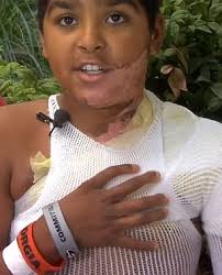 Boy, 12, is severely burned after friend dumped unknown liquid