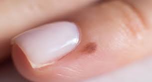 Image result for Acral lentiginous melanoma nail