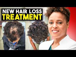 The Non Surgical Hairloss Treatment You NEED To Know About: Alma TED  Explained