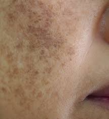 Image result for Melasma