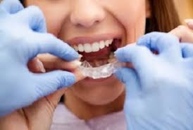 This depends on which type of invisalign retainer you have and how well you look after it. Invisalign Cost How Much Are Invisalign Adult Teen Kids 2021 Costa Mesa Ca Dentistry At Its Finest