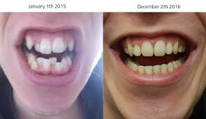 I know it wasn't to extend out payments or anything because the contract stated that the cost was the same regardless of how long it took. After Almost Two Years I Just Got My Braces Off Album On Imgur
