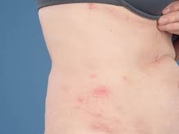 Dermatoloog drs leenarts over de eikenprocessierups, de harige rups die huiduitslag veroorzaakt. Eikenprocessierups Dermatitis