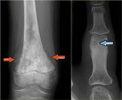 Calcifications occurring in a benign tumor or in a malignant tumor that is well differentiated may be the product of endochondral ossification. The Radiology Assistant Differential Diagnosis Of Bone Tumors