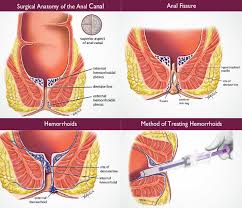 Image result for hemoroid human