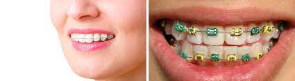 How to get braces for free in south africa. Costs Fees Orthodontist Pretoria Dr Mohamed Imran Khan