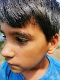 Some people can't survive 1 bee sting. Andrew survived hundreds.