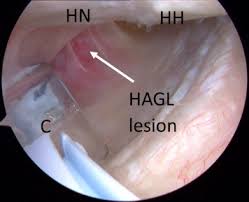 Tin tức mới nhất về hagl: Arthroscopic Repair Of Humeral Avulsion Of The Glenohumeral Ligament Lesion Sciencedirect