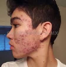 Acne Afecta A 7 De Cada 10 Adolescentes